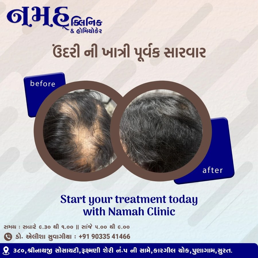 Alopecia treatment result — before and after at Namah Clinic