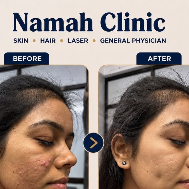 Acne treatment result: before and after photos at Namah Clinic