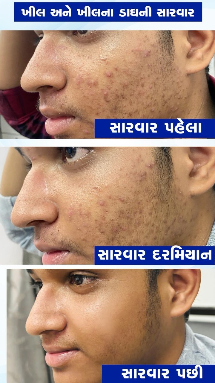 Acne treatment at Namah Clinic — real patient skin close-up