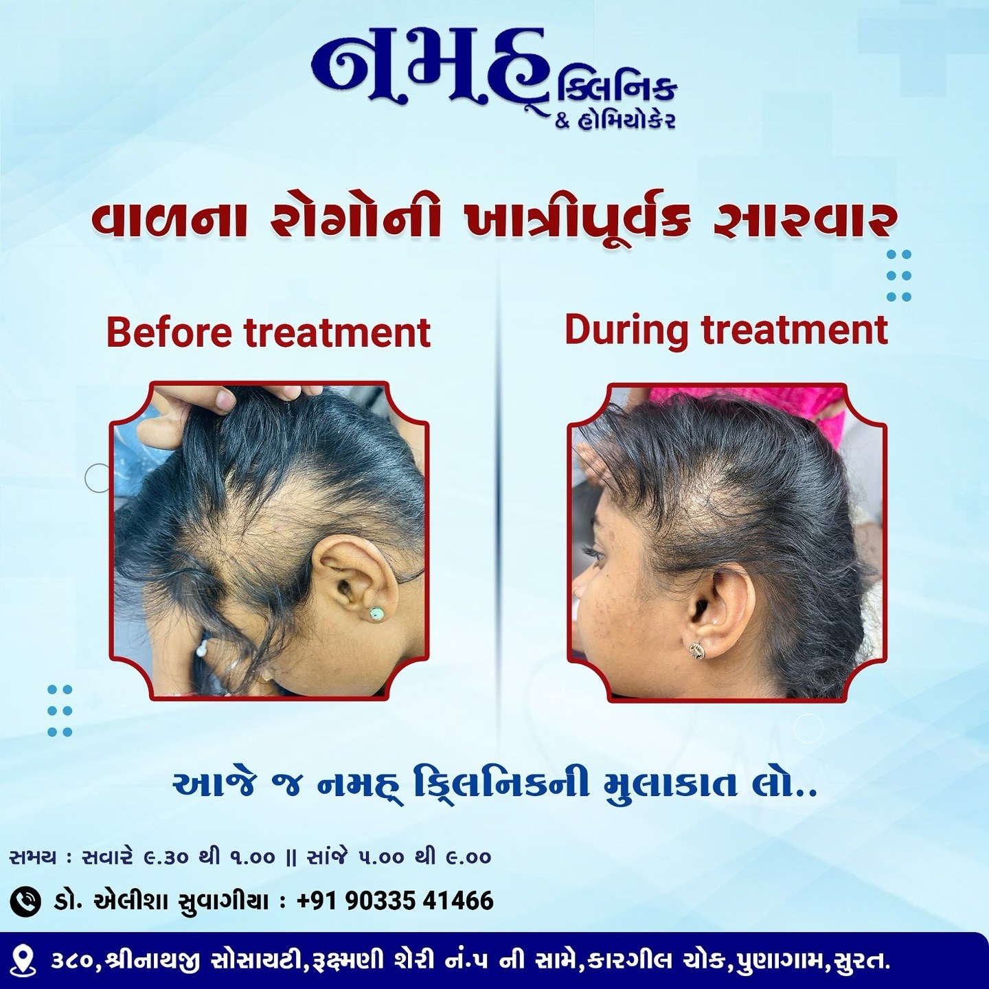 Hairfall treatment result: before and during treatment photos